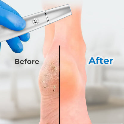 🌸Rajoitetun ajan erikoistarjous!!🌸 Sähköinen jalkakovettumien poistolaite