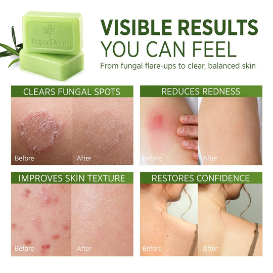 ✨2026 HOT SALE New Arrival🔥 Tea Tree Oil Soap