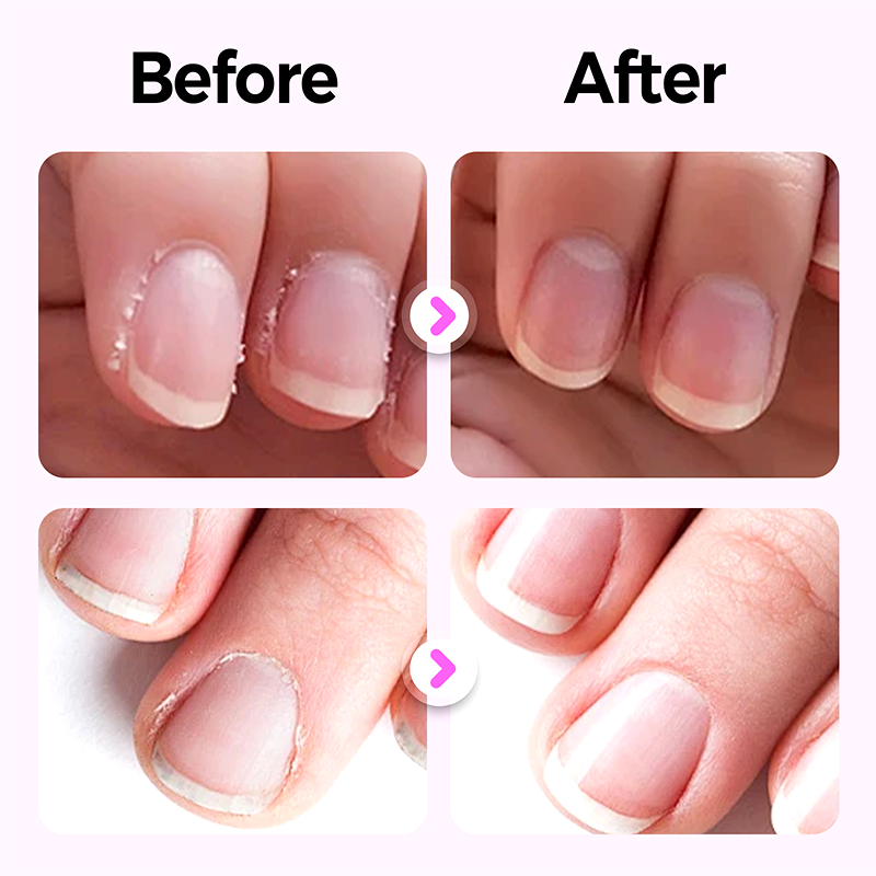 2 KAUFEN, 1 GRATIS💅3-in-1 Nagelpflegestift